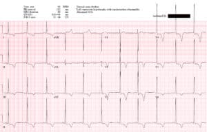 Casos EM | Casos de ECG 13: HVI + IM por oclusión - blogfarmaceutico.com