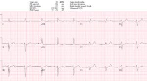 Onda R Ecg Casos de ECG 15: Onda R alta en V1 - blogfarmaceutico.com